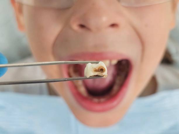 Best Broken or Cracked Tooth Emergency Dentist in Shaw Heights, CO